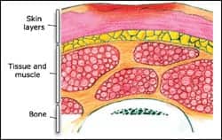 Seating and pressure ulcers: clinical practice guideline