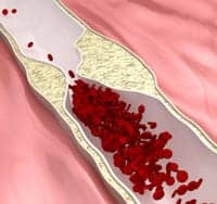 Stroke Risk Strongly Associated with Coronary Atherosclerosis, Study Says