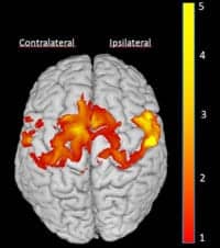 Study: CI Therapy May Increase Grey Matter Production in CP Patients