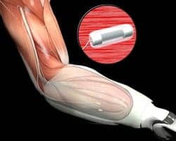 Nerve and Muscle Interfaces to Advance Prosthetic Control and Feedback