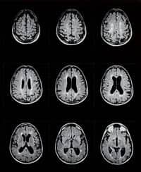 Study Disputes Link Between MS and CCSVI