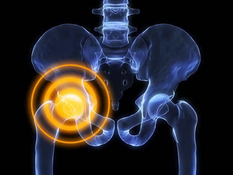 Hip Implant Study Indicates Potential Area of Concern in Current Regulation Process