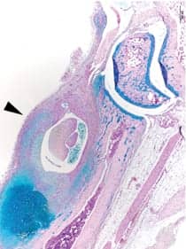 Researchers Spotlight Gene Variant’s Role in the Development of Arthritis