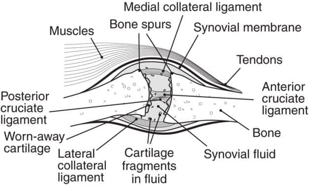 Growth Factor Shows Promise as Knee Osteoarthritis Treatment