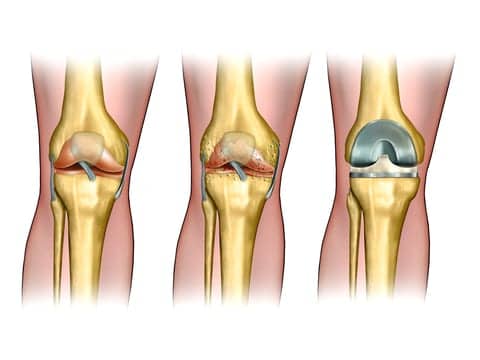 VA Research Finds Kinematic Knee Replacement Improves Postsurgery Pain and ROM