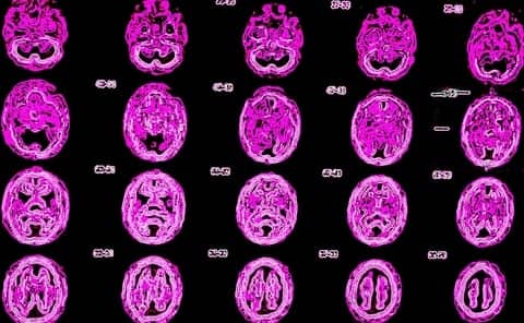 Neuroinflammation in Chronic Pain Patients Offers Objective Measure of Pain