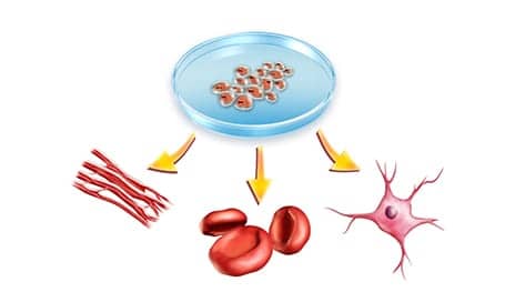 Skin Cells from Diabetic Foot Ulcers May Be Used to Treat Chronic Wounds