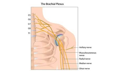 Algorithm Identifies Brachial Plexus-Injured Patients Likely to Benefit from Prosthetic Hand