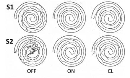 UW Researchers Develop Essential Tremor Treatment That Delivers Targeted Stimulation