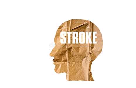 Diagnosis and Treatment of Ischemic Stroke in Young Women Requires a Multidisciplinary Approach