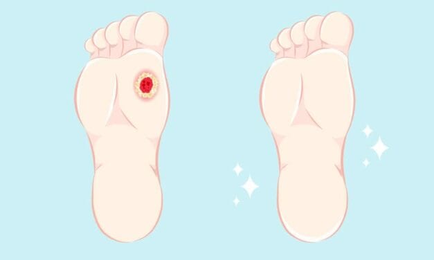 Foot Ulcer Prevention Goes Remote